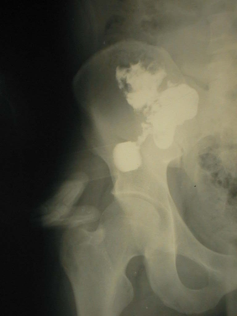 Fistulografia.